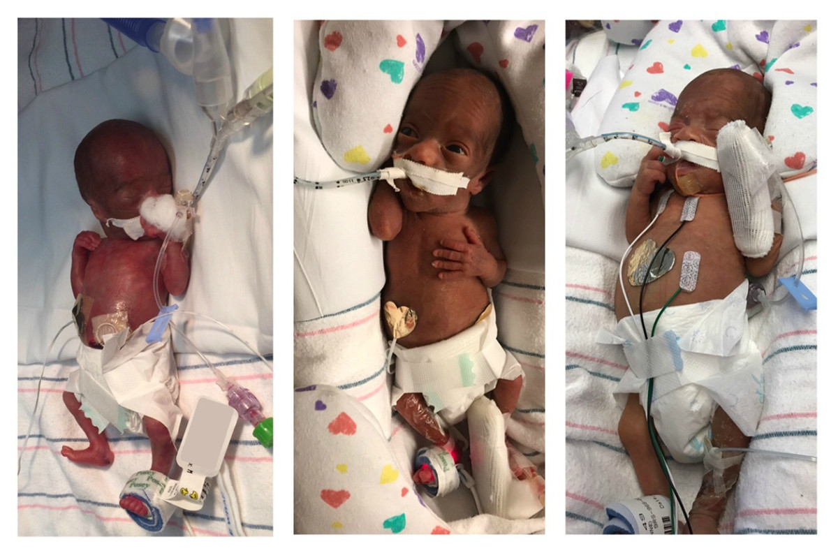 three pictures of a premature young infant